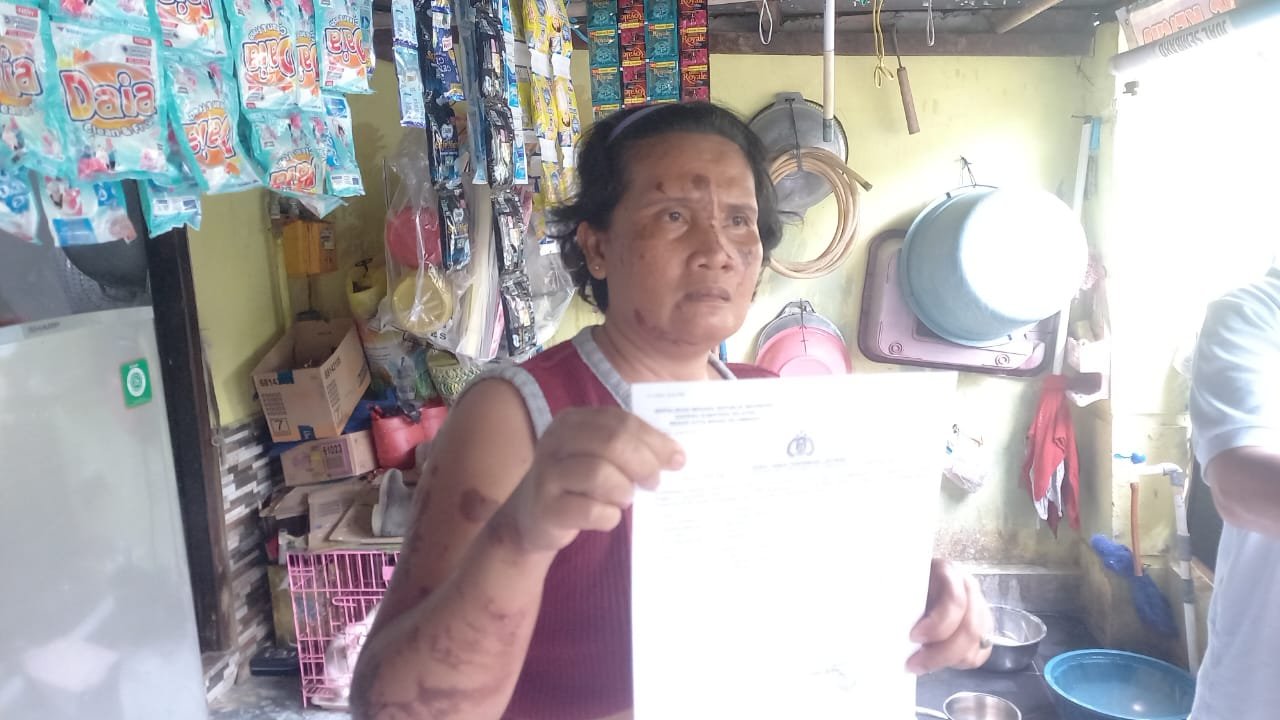 Korban Rohmawati menjadi korban penyiraman air keras. (Foto : Halopos.id)