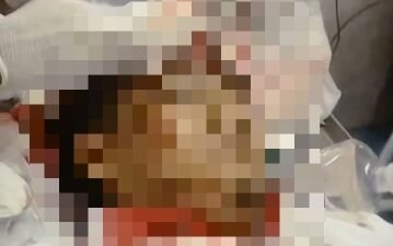 Ketua Kontingen FORKI dari Aceh Tenggarang Tertimpa Reruntuhan Saat Gempa