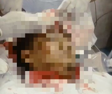 Ketua Kontingen FORKI dari Aceh Tenggarang Tertimpa Reruntuhan Saat Gempa